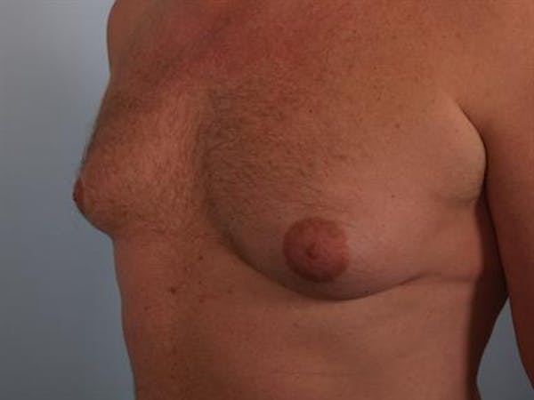 Male Breast/Areola Reduction Gallery - Patient 1310967 - Image 5