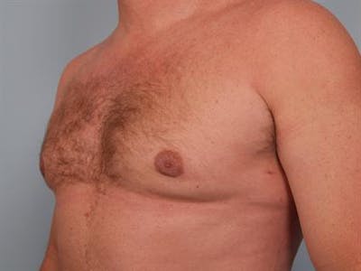 Male Breast/Areola Reduction Before & After Gallery - Patient 1310967 - Image 6