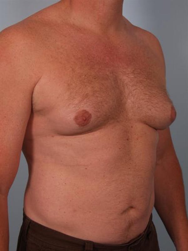 Male Breast/Areola Reduction Before & After Gallery - Patient 1310967 - Image 7