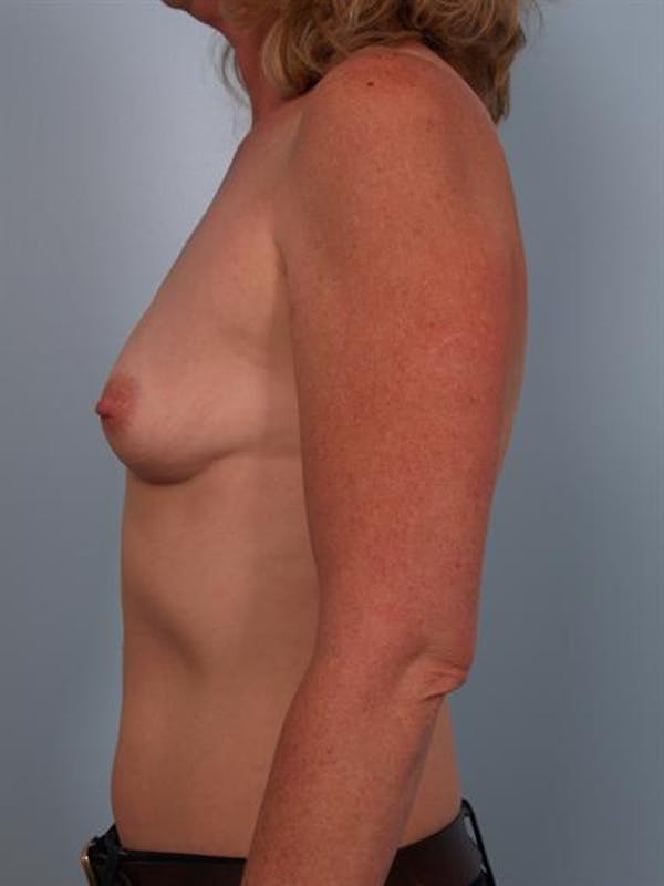 Breast Augmentation Gallery - Patient 1310975 - Image 1
