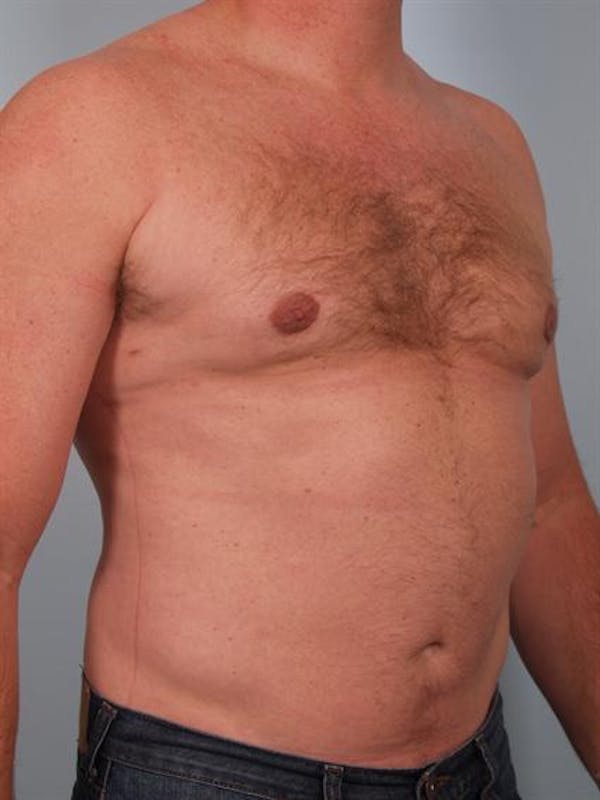 Male Breast/Areola Reduction Before & After Gallery - Patient 1310967 - Image 8