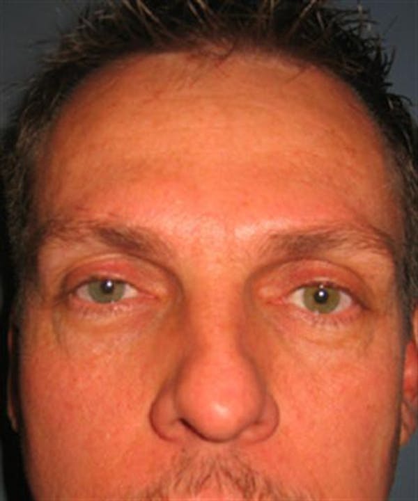 Restylane Before & After Gallery - Patient 1310971 - Image 3