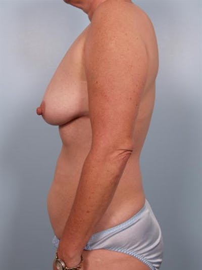 Tummy Tuck Before & After Gallery - Patient 1310972 - Image 1