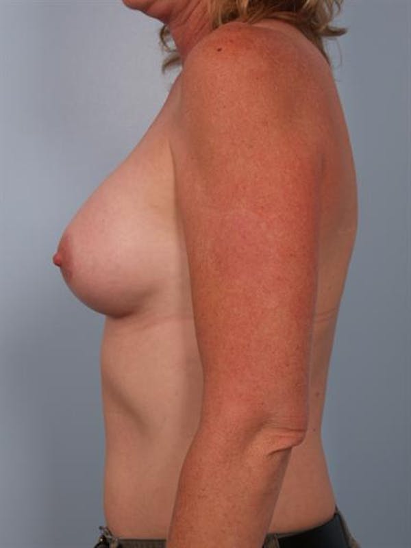 Breast Augmentation Before & After Gallery - Patient 1310975 - Image 2