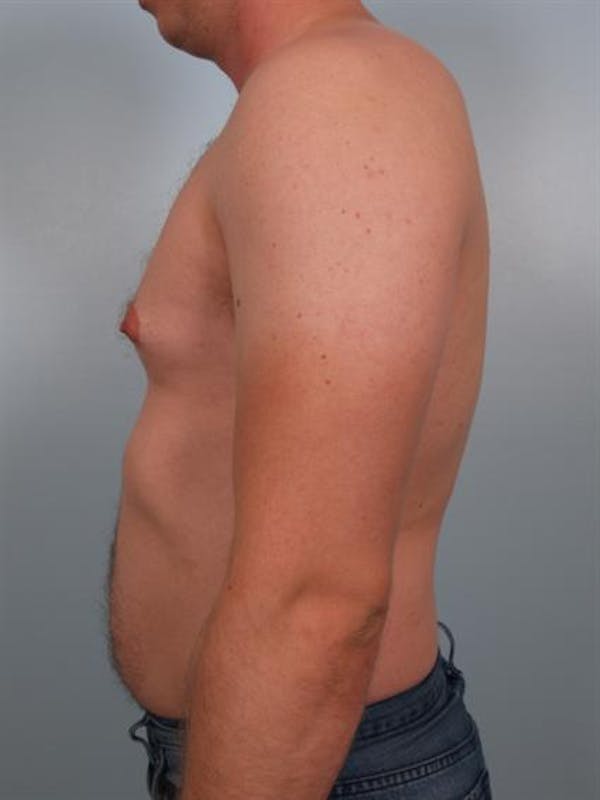 Male Breast/Areola Reduction Gallery - Patient 1310974 - Image 1