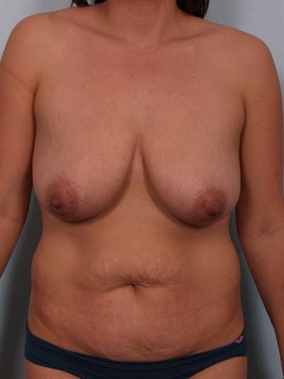 Mommy Makeover Before & After Gallery - Patient 1310977 - Image 1