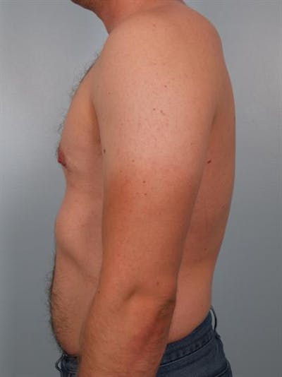 Male Breast/Areola Reduction Before & After Gallery - Patient 1310974 - Image 2