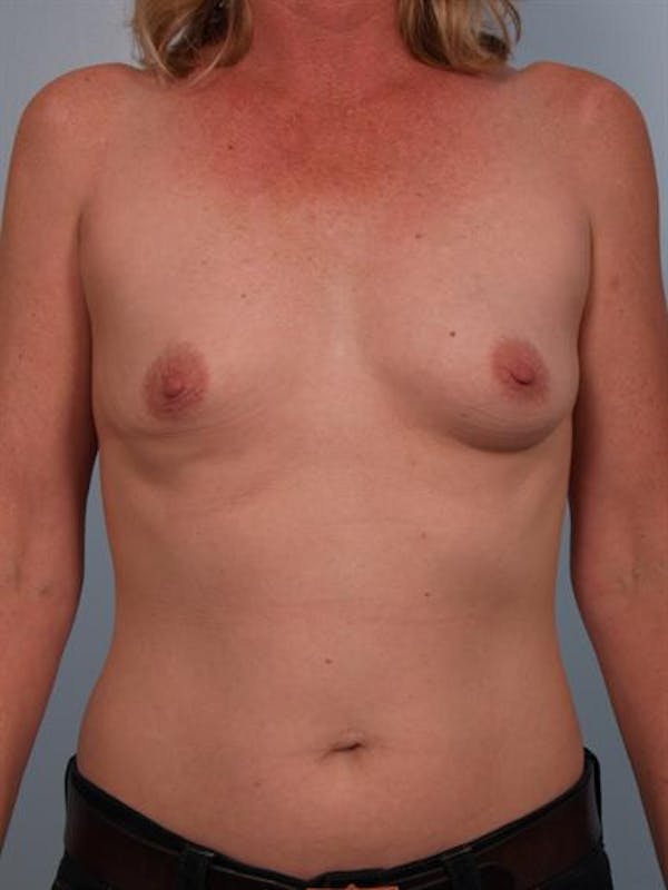 Breast Augmentation Before & After Gallery - Patient 1310975 - Image 5