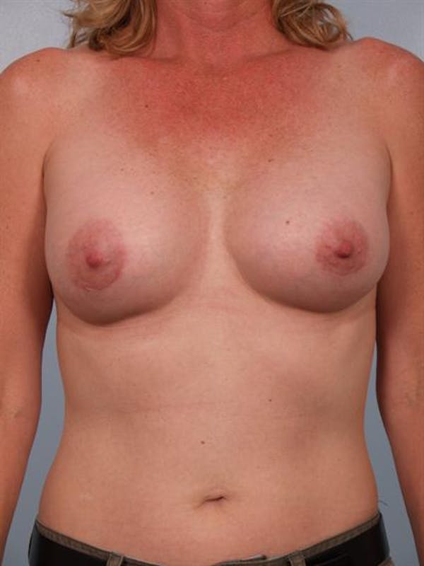 Breast Augmentation Before & After Gallery - Patient 1310975 - Image 6