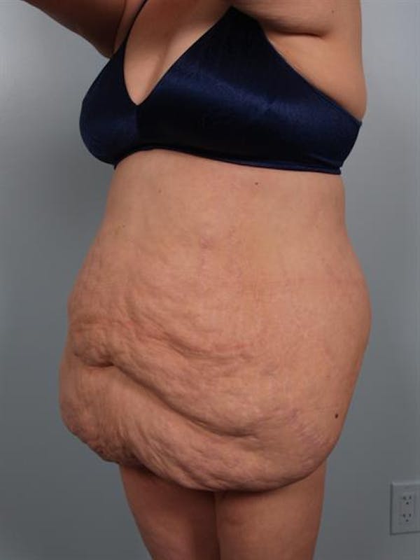 Power Assisted Liposuction Before & After Gallery - Patient 1310978 - Image 5