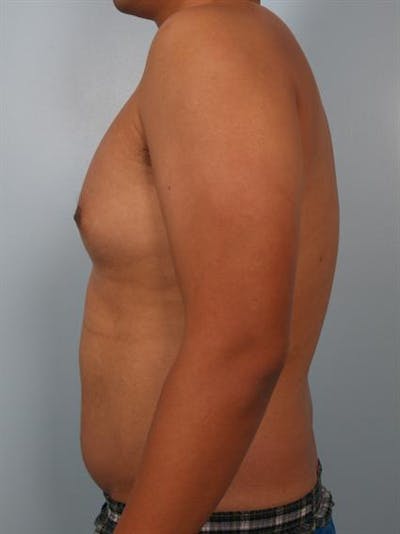 Male Breast/Areola Reduction Gallery - Patient 1310980 - Image 1