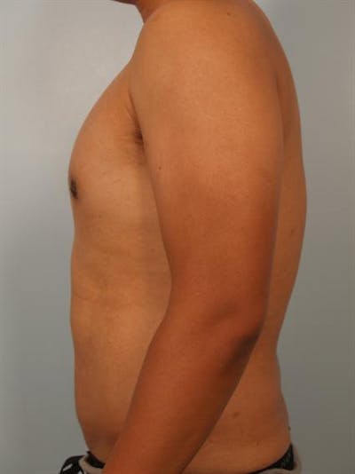Male Breast/Areola Reduction Gallery - Patient 1310980 - Image 2