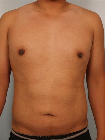 Male Breast/Areola Reduction Before & After Gallery - Patient 1310980 - Image 4