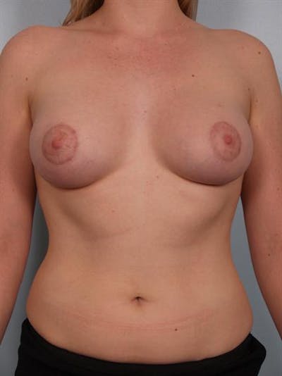 Power Assisted Liposuction Before & After Gallery - Patient 1310981 - Image 2