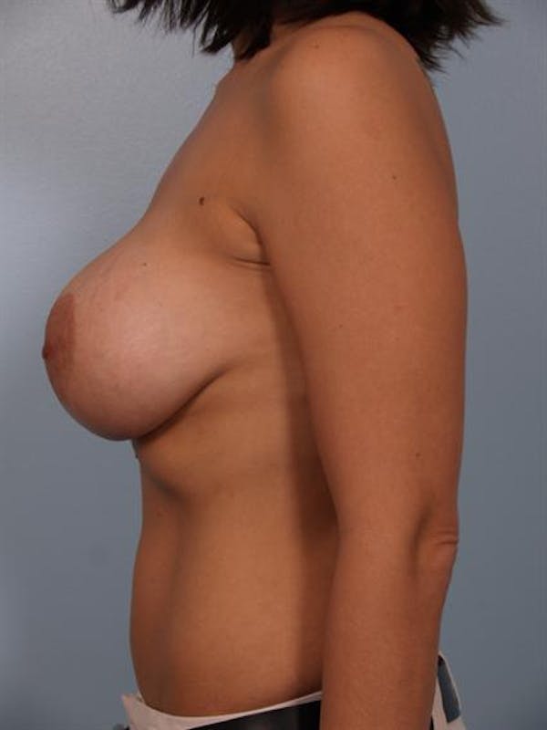 Breast Lift Before & After Gallery - Patient 1310985 - Image 5