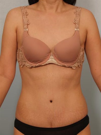Tummy Tuck Before & After Gallery - Patient 1310983 - Image 2