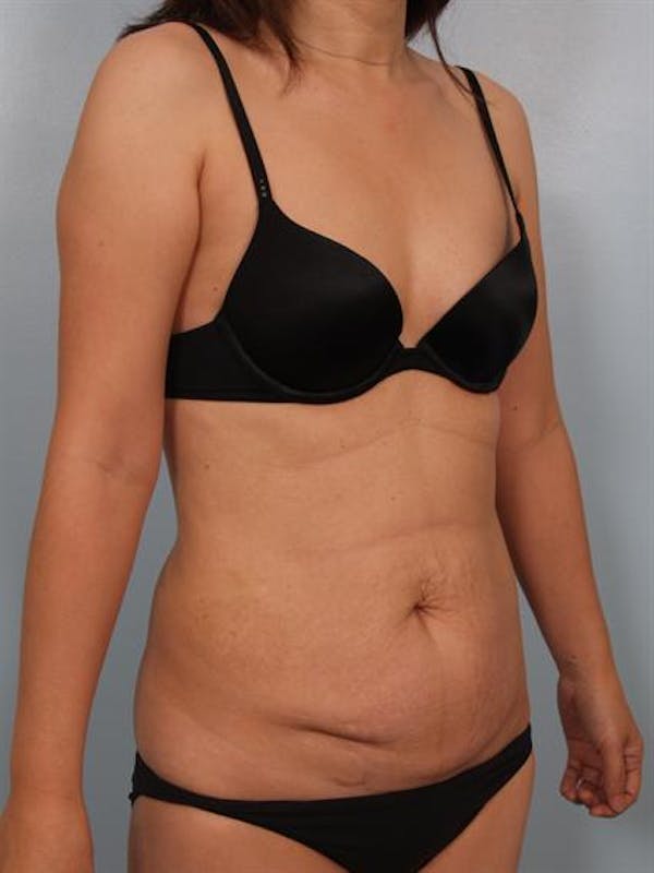 Tummy Tuck Gallery - Patient 1310983 - Image 3