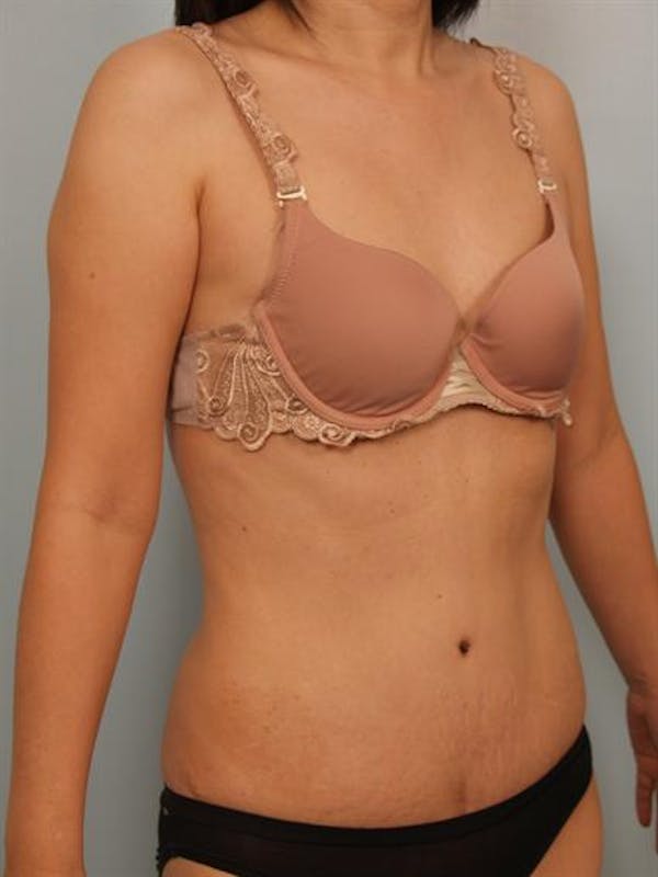 Tummy Tuck Before & After Gallery - Patient 1310983 - Image 4