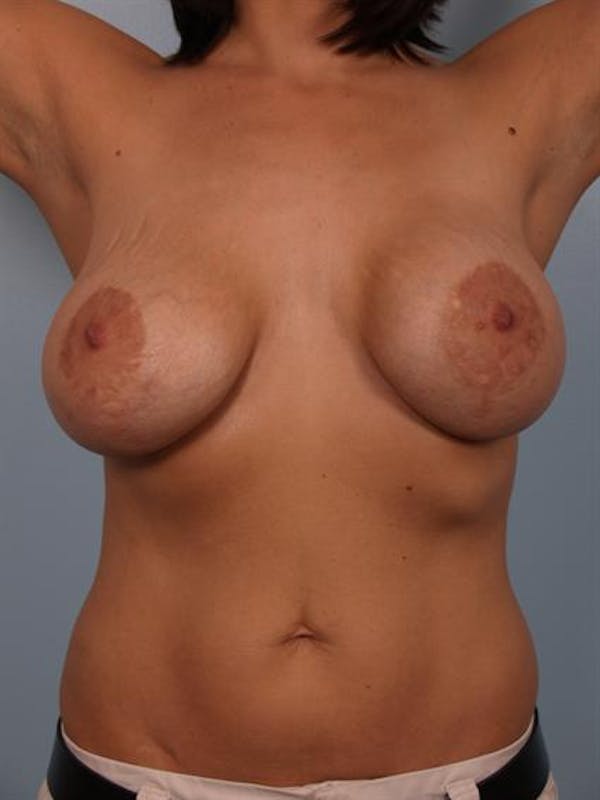 Breast Lift Before & After Gallery - Patient 1310985 - Image 9
