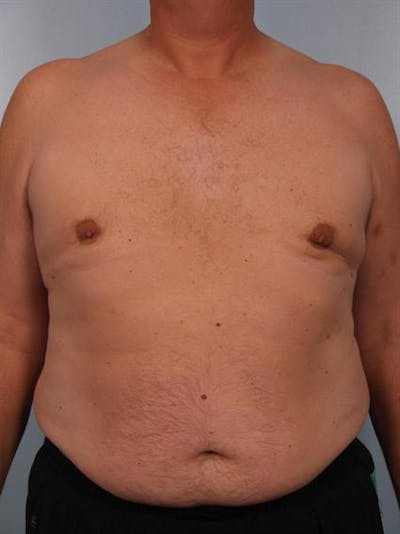 Male Breast/Areola Reduction Before & After Gallery - Patient 1310984 - Image 4