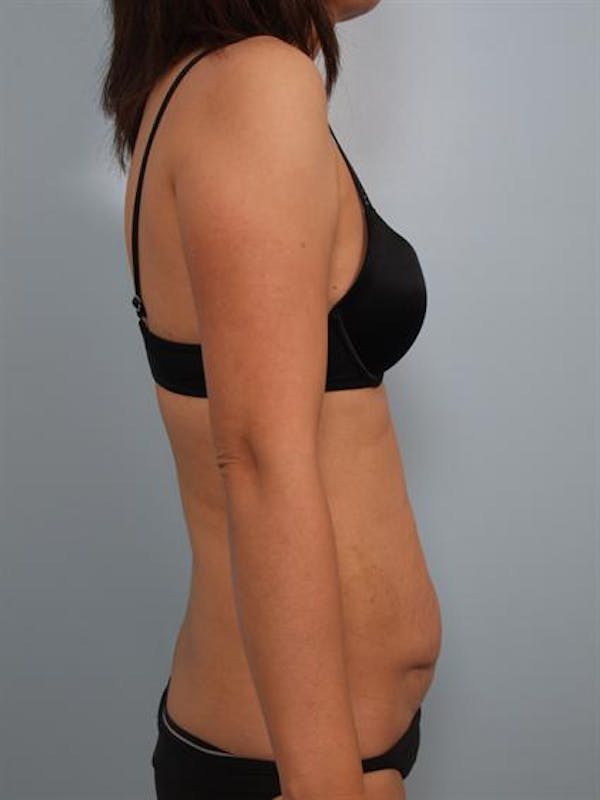 Tummy Tuck Gallery - Patient 1310983 - Image 5