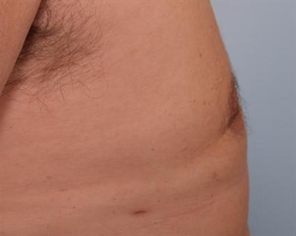 Male Breast/Areola Reduction Before & After Gallery - Patient 1310984 - Image 6