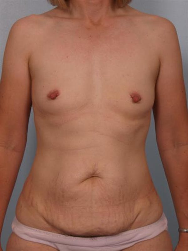 Tummy Tuck Before & After Gallery - Patient 1310988 - Image 1