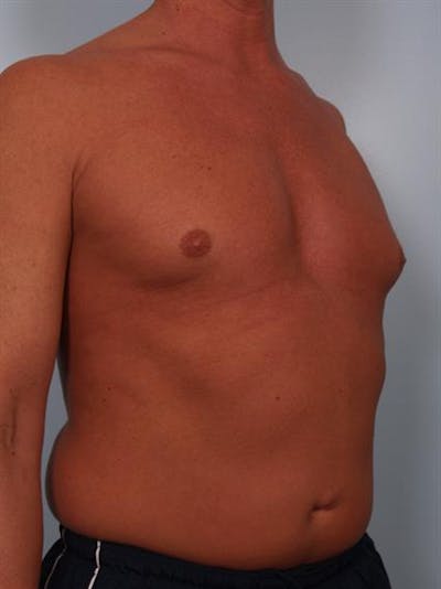 Male Breast/Areola Reduction Gallery - Patient 1310991 - Image 1