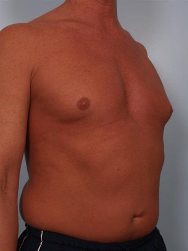 Male Breast/Areola Reduction Before & After Gallery - Patient 1310991 - Image 1