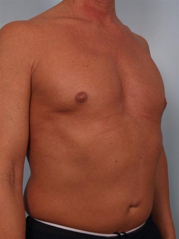 Male Breast/Areola Reduction Before & After Gallery - Patient 1310991 - Image 2