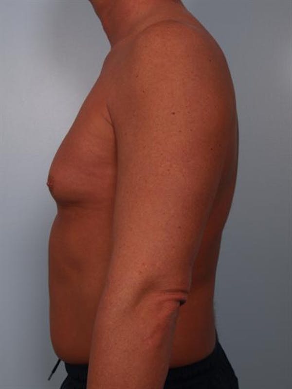 Male Breast/Areola Reduction Before & After Gallery - Patient 1310991 - Image 3