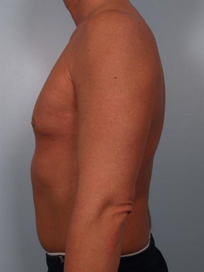 Male Breast/Areola Reduction Before & After Gallery - Patient 1310991 - Image 4