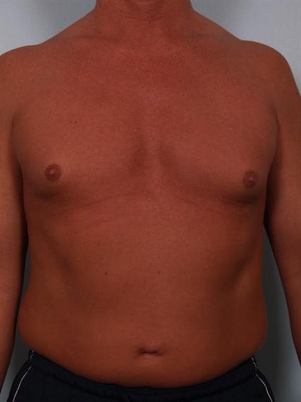 Male Breast/Areola Reduction Before & After Gallery - Patient 1310991 - Image 5