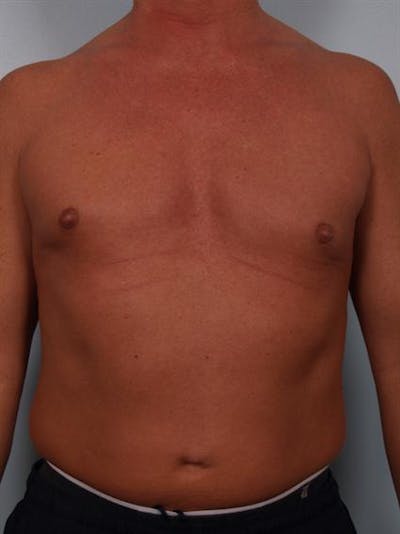 Male Breast/Areola Reduction Gallery - Patient 1310991 - Image 6
