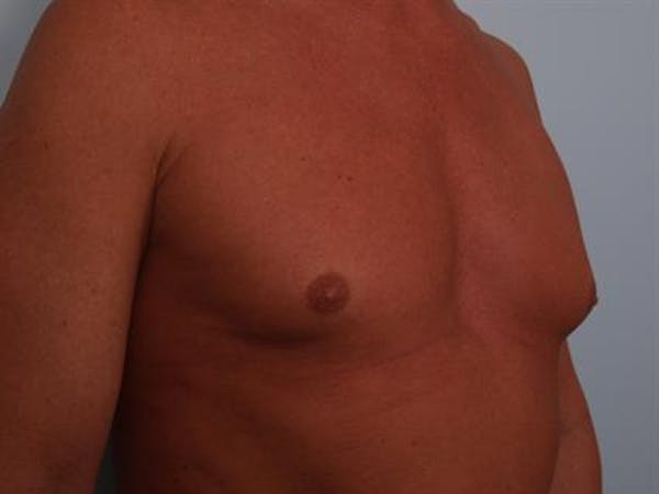 Male Breast/Areola Reduction Before & After Gallery - Patient 1310991 - Image 7