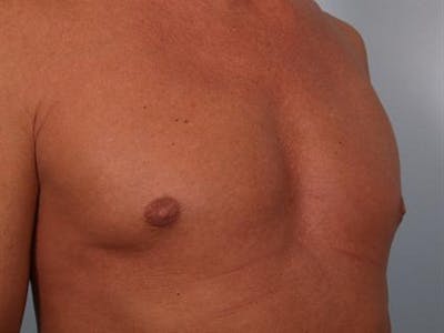 Male Breast/Areola Reduction Before & After Gallery - Patient 1310991 - Image 8