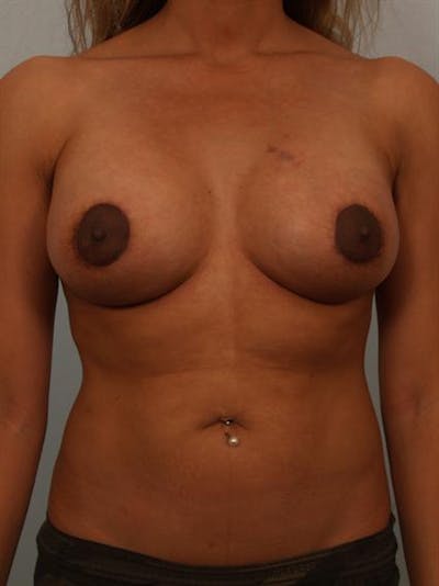 Power Assisted Liposuction Before & After Gallery - Patient 1310993 - Image 2