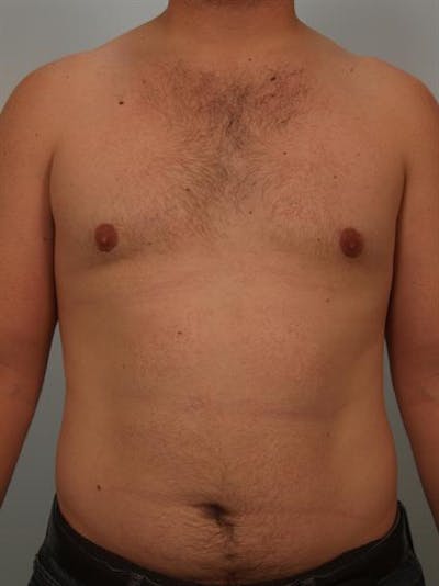 Male Breast/Areola Reduction Gallery - Patient 1310992 - Image 2