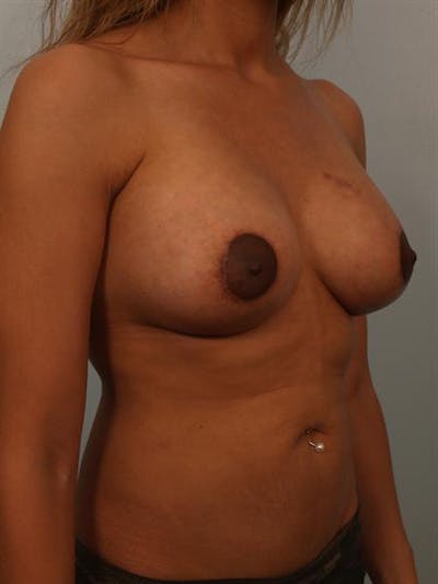 Power Assisted Liposuction Gallery - Patient 1310993 - Image 4