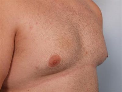 Male Breast/Areola Reduction Before & After Gallery - Patient 1310997 - Image 1