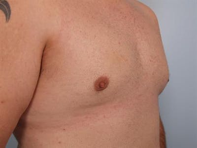 Male Breast/Areola Reduction Gallery - Patient 1310997 - Image 2