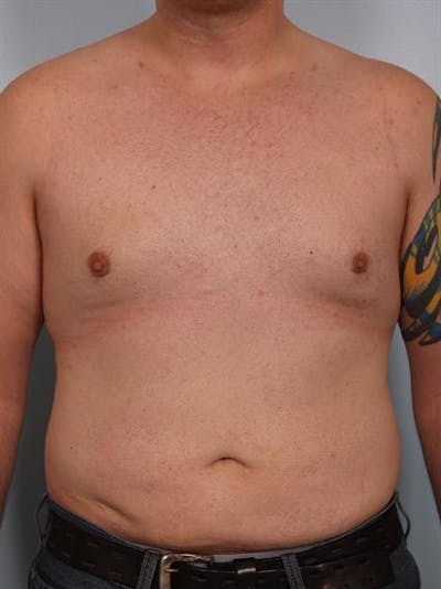 Male Breast/Areola Reduction Gallery - Patient 1310997 - Image 4