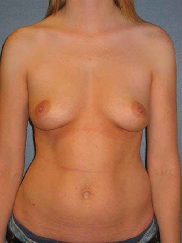 Breast Augmentation Before & After Gallery - Patient 1310999 - Image 3