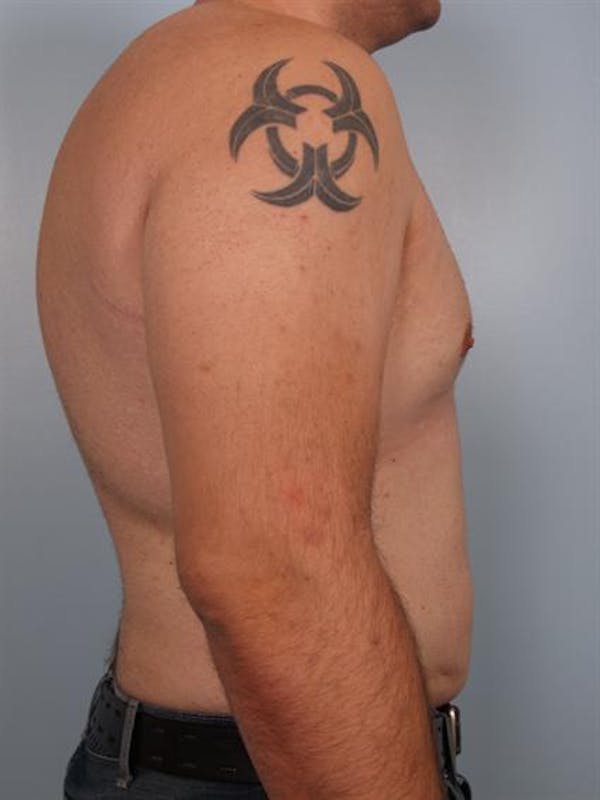 Male Breast/Areola Reduction Before & After Gallery - Patient 1310997 - Image 6