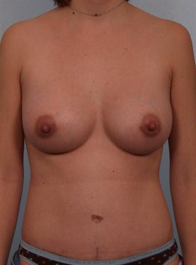 Power Assisted Liposuction Before & After Gallery - Patient 1310998 - Image 6
