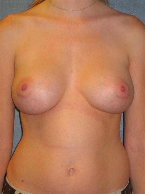 Breast Augmentation Gallery - Patient 1310999 - Image 4