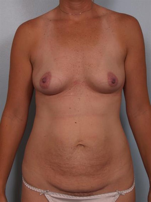 Power Assisted Liposuction Before & After Gallery - Patient 1311003 - Image 1
