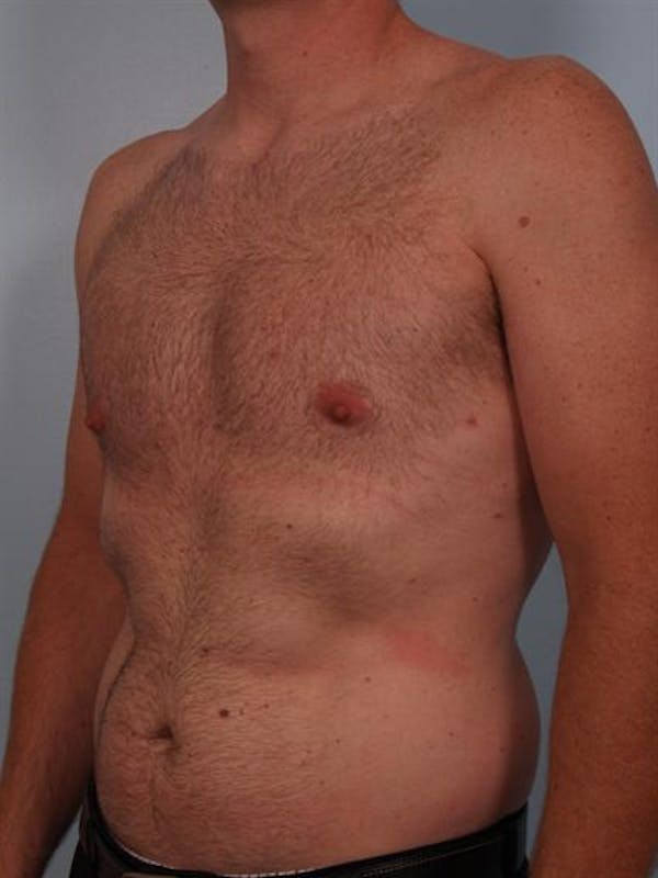 Male Breast/Areola Reduction Before & After Gallery - Patient 1311002 - Image 4