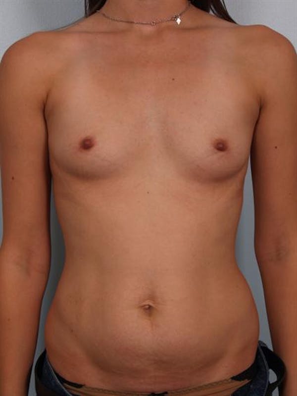 Breast Augmentation Before & After Gallery - Patient 1311004 - Image 1