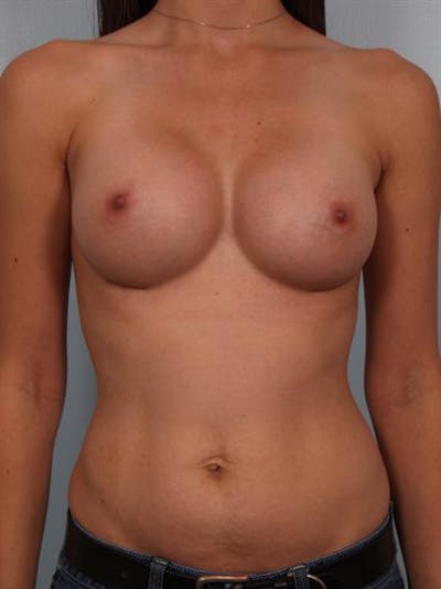 Breast Augmentation Before & After Gallery - Patient 1311004 - Image 2